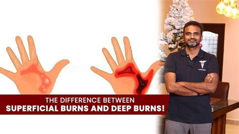 The Difference Between Superficial Burns And Deep Burns Dr Sree