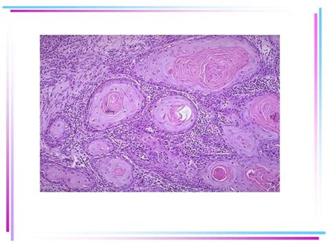 Carcinoma Escamoso De Cuello Uterino