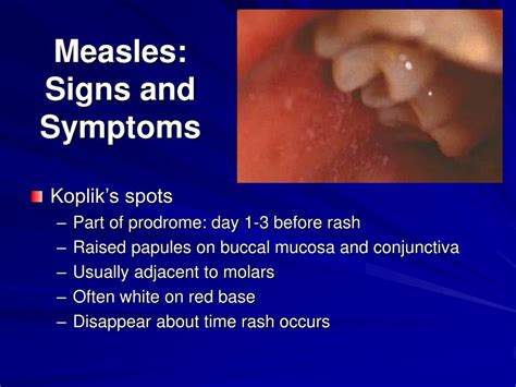 Ppt Measles And Neonatal Tetanus Clinical Signs And Treatment