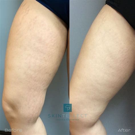 Stretch Marks Scar Removal Fotona Advanced Lasers