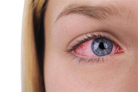 6 Ways Seasonal Allergies Affect Your Eyes - Weston Contact Lens Institute