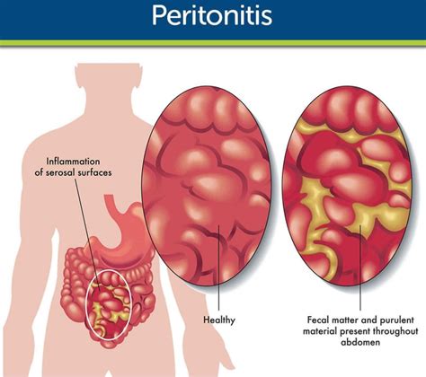 Peritonitis Penyebab Gejala Komplikasi Dan Pengobatan