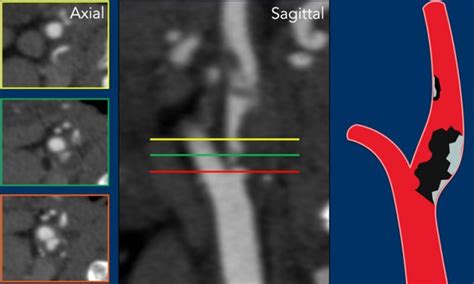 The Radiology Assistant How To Differentiate Carotid Obstructions