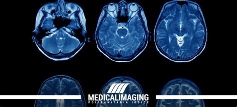 Ictus La Risonanza Magnetica All Encefalo Per Approfondire