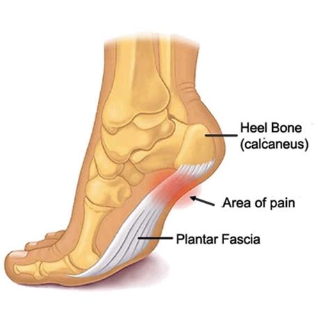 Management And Treatment Of Plantar Fasciitis With Mr Bal Dhinsa One Healthcare