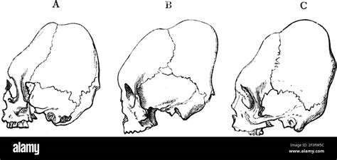 Deformed skulls hi-res stock photography and images - Alamy