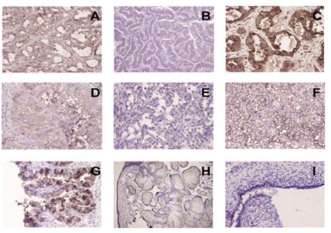 The Diagnosis And Pathological Value Of Combined Detection Of He And