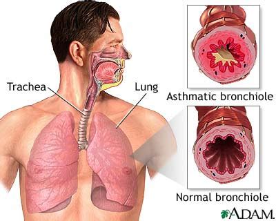 ithoxs: Asthma Attack