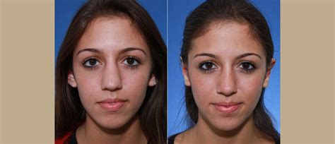 Steiger Facial Plastic Surgery Boca Raton Facelift Rhinoplasty