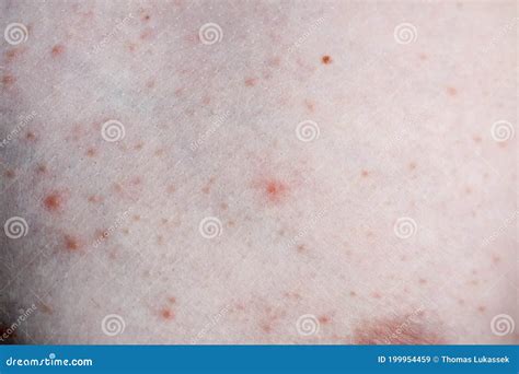 Close Up Image Of A Little Boy`s Body Suffering Severe Urticaria