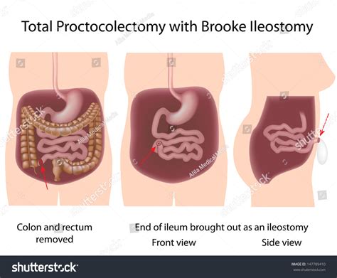 Brooke Ileostomy Colon Surgery Stock Illustration 147789410 Shutterstock