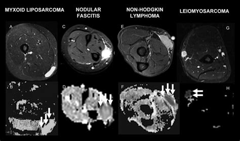 Tissue Characterization Of Soft Tissue Lesions Myxoid Liposarcoma In