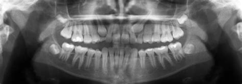 Impacted Canines Oral And Maxillofacial Surgery Oms Nashville