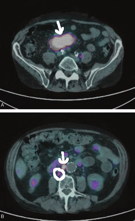 A Mesenteric Mass En Bloc With Lymph Nodes Cm Mass With Fused