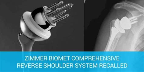 Zimmer Shoulder Replacement Device Gets Fda Class Recall