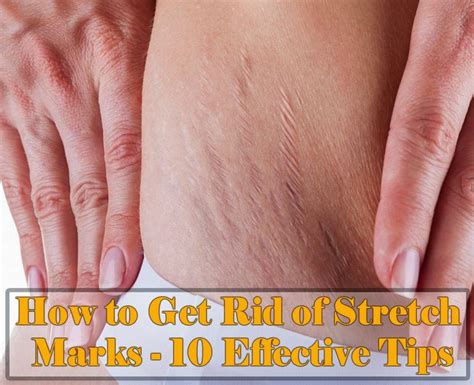 How To Get Rid Of Stretch Marks 10 Effective Tips How To Get Rid