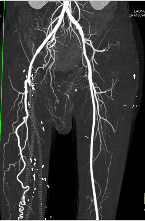 Cta Runoff With Occlusion Of Vascular Grafts Using Bone Removal