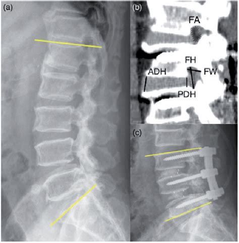 Figure 1 From Contralateral Radiculopathy After Unilateral