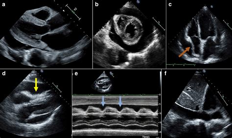 Cardiac Tamponade Echo