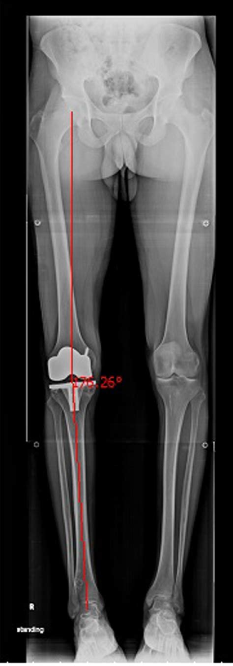 Full Length Standing Position Anterior Posterior Radiograph Of Both