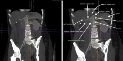 Gastroduodenal Artery Ultrasound