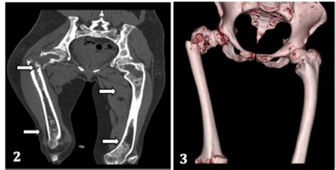 Polyostotic Fibrous Dysplasia