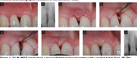 Minimally Invasive Surgical Techniques In Periodontal Regeneration