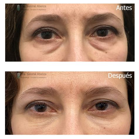 Blefaroplastia Superior E Inferior Con Cantopexia Bilateral Con