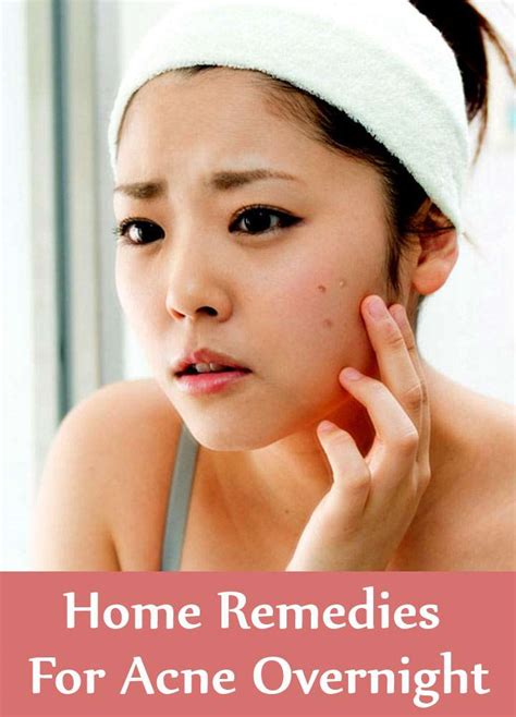 9 Home Remedies For Acne Overnight Search Home Remedy