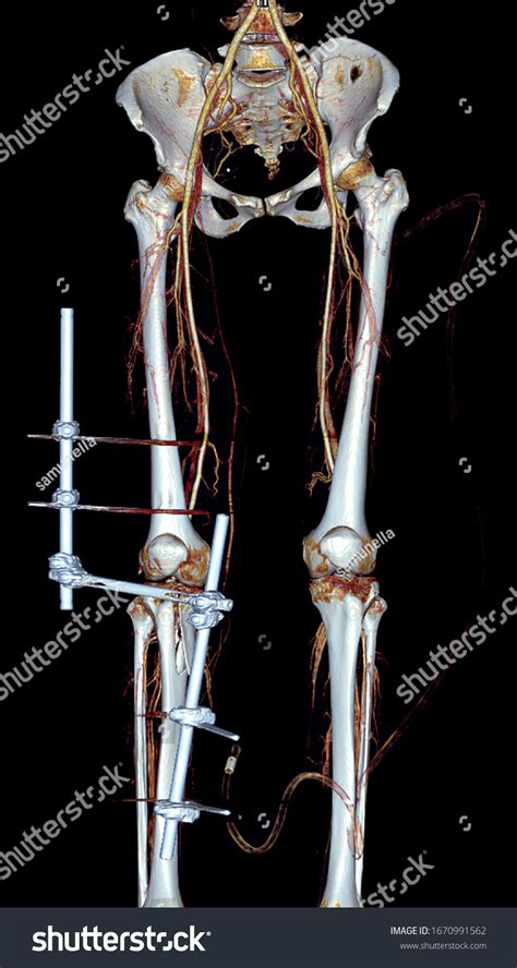 Cta Femoral Artery Run Off 3d Stock Illustration 1670991562 Shutterstock