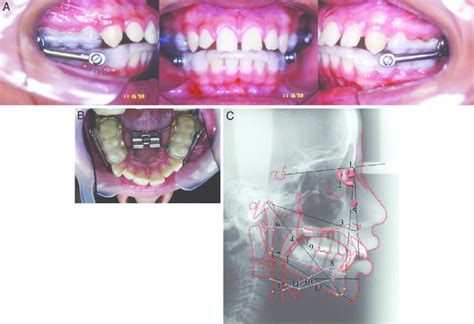 A The Acrylic Splint Herbst Appliance B Rapid Maxillary Expander