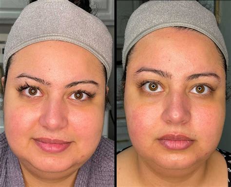 RF Skin Tightening Facial Body Contouring Contoura MedSpa