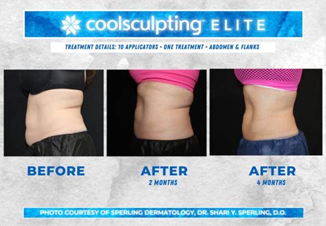 Before and After CoolSculpting Photos