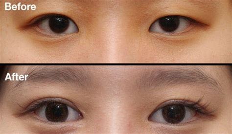 Double Eyelid Surgery In Korea What You Need To Know Jivakacare