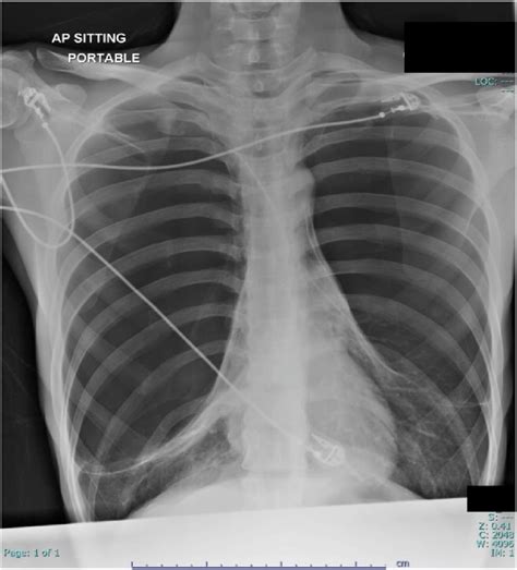 Chest Radiograph Upon Initial Presentation To Emergency Department