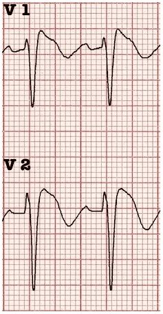 Brugada Syndrome LITFL ECG Library Diagnosis