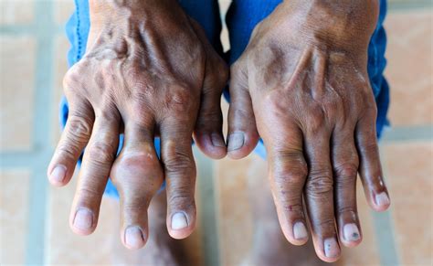 Gicht Symptome Ursachen Ernährung und Behandlung