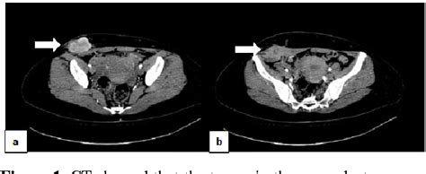 Figure 1 From Endometrioid Adenocarcinoma Arising From Abdominal Wall