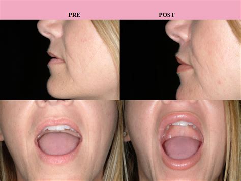 Lip-Augmentation-Before-and-After-6 - New Youth Medical Spa