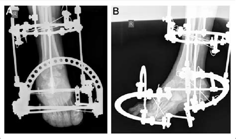 Immediate Postoperative Anteroposterior A And Lateral B Radiographs