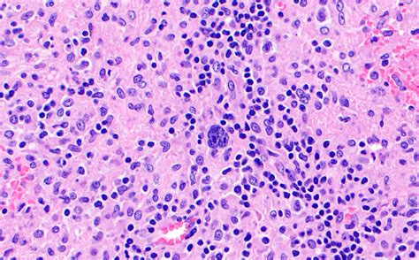 Pathology Outlines Ptld Classic Hodgkin