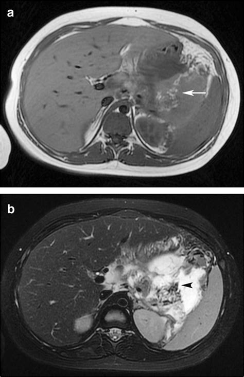 Necrotizing pancreatitis in a 4-year-old girl. a, b Axial T1-weighted... | Download Scientific ...