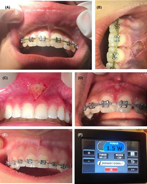 Labial Frenectomy Before And After