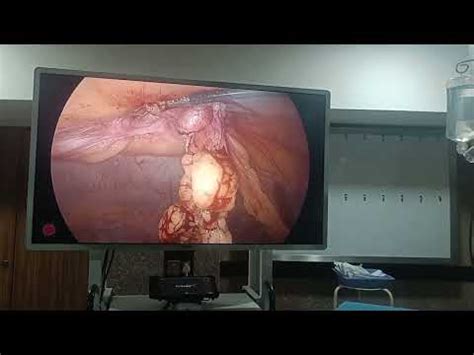 Incisional Hernia Port Site Hernia Youtube