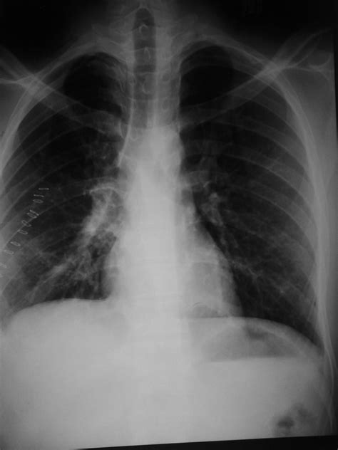 Posterior Mediastinal Mass Diagnosed As Schwanomma With Concomittant Tuberculosis Bmj Case Reports