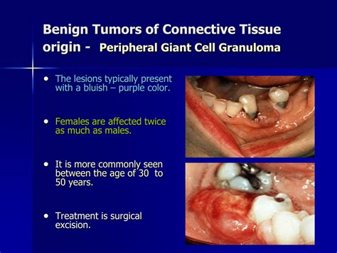 Ppt Comprehensive Guide To Benign Oral Tumors Powerpoint Presentation