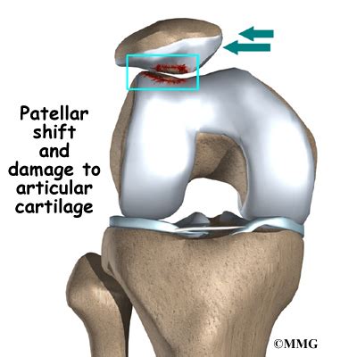 Condromalacia rotuliana.