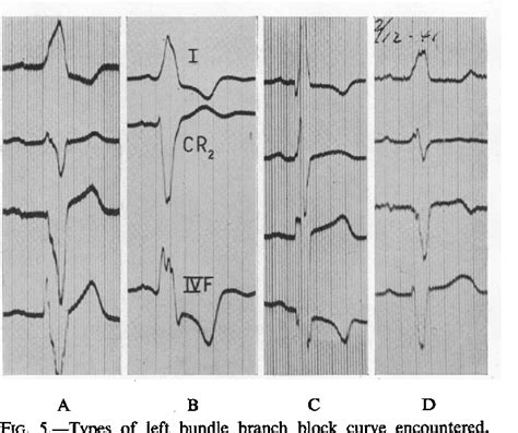 Figure 1 From Pathogenesis Of Left Bundle Branch Block By Hakon Rasmussen And Torjus Moe