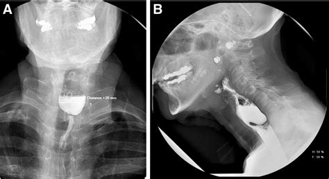 Zenker S Diverticulum Clinical Gastroenterology And Hepatology