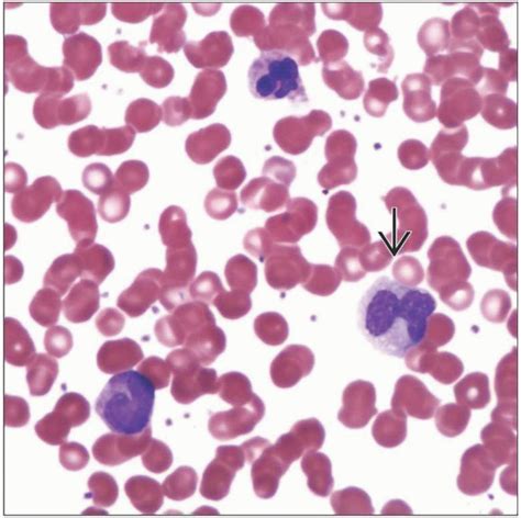 Monocytosis | Basicmedical Key